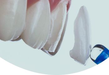 Виниры защищают родную эмаль зубов